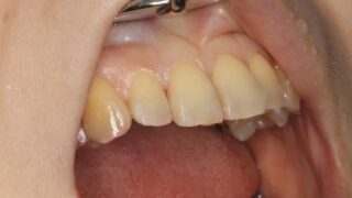 「前歯を綺麗に治すこと～う蝕治療とレジン修復」