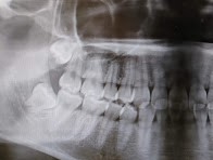 矯正治療のための親知らず抜歯