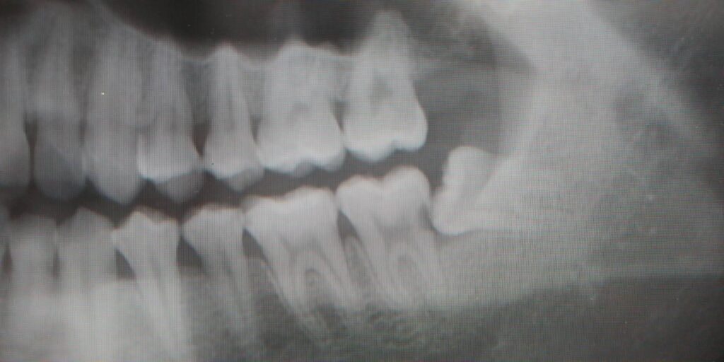 半埋伏歯症例1