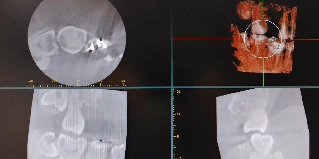 智歯の抜歯ナビゲ-ション 智歯の抜歯ナビゲーション - クインテッセンス出版