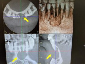 初診時のCT画像